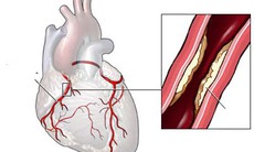 Một số loại thuốc ngừa tai biến vữa xơ động mạch
