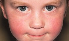 Lupus ban đỏ hệ thống không thể chữa khỏi