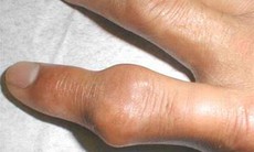 Bệnh giả gút và gút khác nhau thế nào?