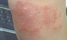 Ánh nắng giúp giảm nguy cơ eczema và dị ứng