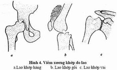 Ðừng để tàn phế vì lao xương khớp