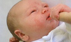Trị viêm da cơ địa ở trẻ sơ sinh