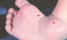 Ðiều trị thành công 4 trường hợp bị khoèo chân không cần phẫu thuật