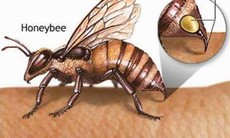 Sơ cứu khi bị ong đốt