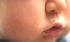 Chảy mũi xanh kéo dài dễ bị viêm xoang