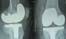 Trường hợp nào cần thay khớp nhân tạo?