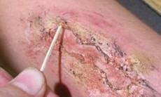 Vết thương sắp lành bị ngứa