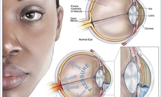 Glaucoma và việc dùng thuốc