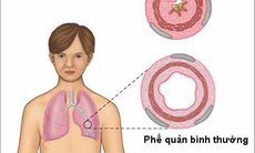 Dự phòng cơn hen phế quản bùng phát khi chuyển mùa