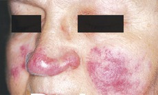 Biến chứng nguy hiểm từ lupus ban đỏ