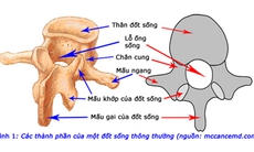 Nguy hiểm khi bị hẹp ống sống