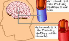 Thuốc điều trị đột quỵ não