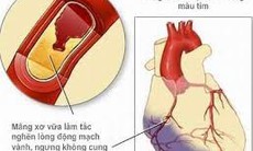 Các nhóm thuốc điều trị nhồi máu cơ tim