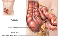 Cảnh giác với biến chứng viêm ruột thừa cấp