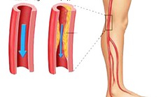 Bệnh động mạch ngoại biên của chi dưới