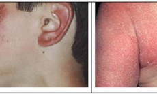 Những trẻ không được dùng corticoid