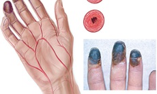 Giải quyết viêm tắc động mạch chi trên bằng phẫu thuật nội soi