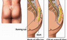 Nang tổ lông là gì?