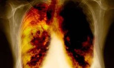 Ai dễ bị ung thư phổi?