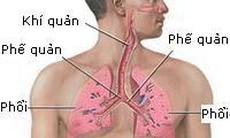 Nguyên nhân gây viêm phế quản 