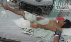 Kinh hoàng: Một người bị máy xay đá lạnh nghiến nát chân