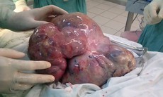 Thiếu nữ mang khối u buồng trứng nặng gần 4kg