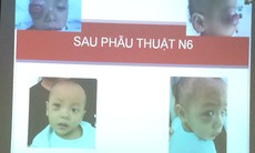 “Giải cứu” mắt khỏi ổ áp xe vì viêm xoang cho trẻ 16 tháng