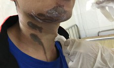 Tưởng nhẹ nhưng bỏng hóa chất có thể ăn sâu vào cơ thể