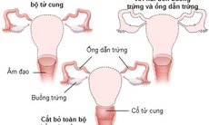 Cắt bỏ tử cung ở phụ nữ trẻ gắn liền với nguy cơ bệnh tim mạch