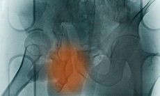 Dùng tế bào gốc điều trị loãng xương