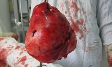 BVĐK Hương Sơn: Phẫu thuật thành công một trường hợp u xơ tử cung lớn, hiếm gặp