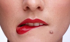 7 liệu pháp trị mụn bọc dễ làm tại nhà