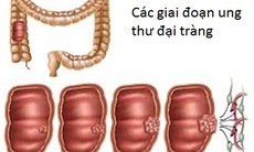 Người có tiền sử gia đình bị ung thư đại tràng nên sàng lọc sớm hơn   