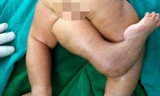 Lạ lùng bé gái sinh ra có 3 chân
