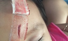 Bị gà mổ có nên tiêm phòng uốn ván?