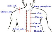 Châm cứu điều trị chắp lẹo