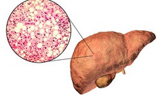 Dấu hiệu sớm “tố” bạn đã bị gan nhiễm mỡ