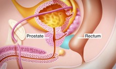 Liệu pháp giảm tác dụng phụ xạ trị ung thư tiền liệt tuyến