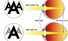 Các tật khúc xạ phổ biến ở trẻ em