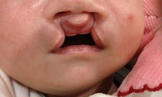 Chương trình phẫu thuật nhân đạo cho trẻ bị dị tật khe hở môi và vòm miệng