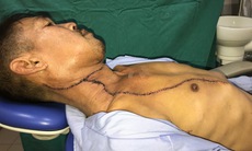 Bước tiến mới trong điều trị ung thư miệng