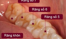 Đừng chủ quan khi nhổ răng khôn