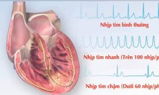 Bài thuốc trị chứng tâm mạch tắc nghẽn