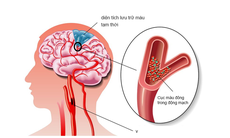 Bài thuốc trị chứng thiểu năng tuần hoàn não