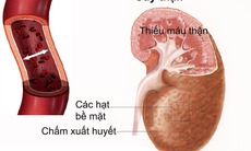 Sỏi bàng quang và biến chứng
