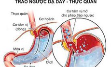 8 dấu hiệu khi mắc trào ngược dạ dày - thực quản