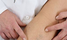 Huyết khối tĩnh mạch có nguy hiểm?