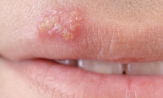 Bệnh do virut Herpes, dùng thuốc gì?