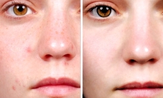 Viêm da dị ứng: đừng tự chữa