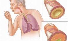 Để bệnh tâm phế mạn không nặng thêm